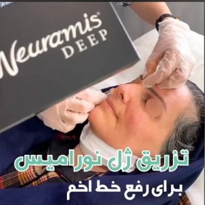 filler-injection-2