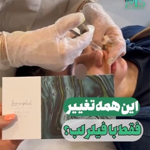 filler-injection-3