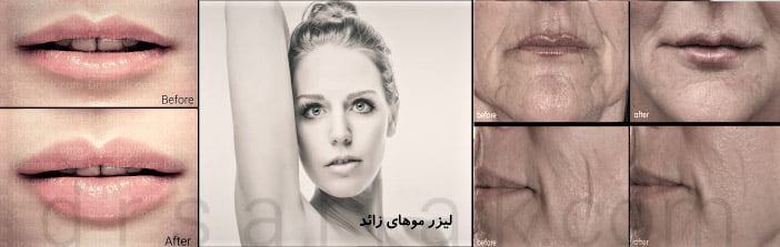 فیلم و تصاویر قبل و بعد عمل های زیبایی