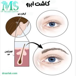 مراحل کاشت ابرو - دکتر مژده سرلک