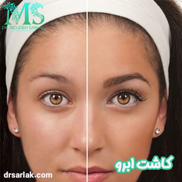 کاشت ابرو - دکتر مژده سرلک