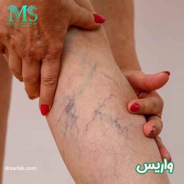 واریس - دکتر مژده سرلک