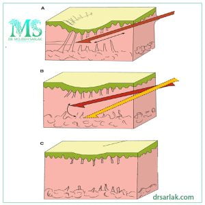 مراحل سابسیژن - دکتر مژده سرلک -drsarlak.com