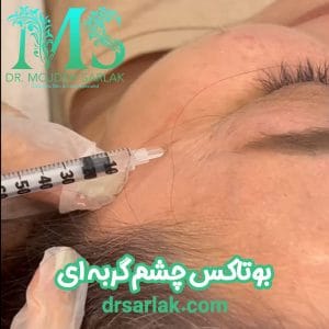 بوتاکس چشم گربه ای - دکتر سرلک - drsarlak.com