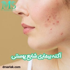 آکنه - دکتر مژده سرلک - drsarlak.com