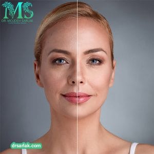 عکس اندولیفت - دکتر مژده سرلک - drsarlak.com