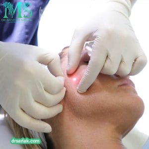 عکس درمان پوست با اندولیفت - دکتر مژده سرلک - drsarlak.com
