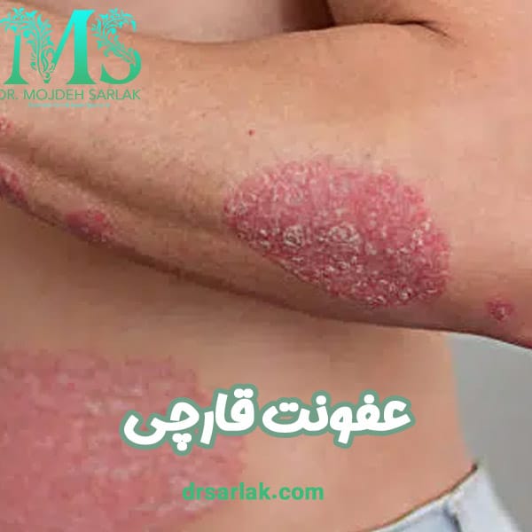 عفونت قارچی - دکتر سرلک -drsarlak.com