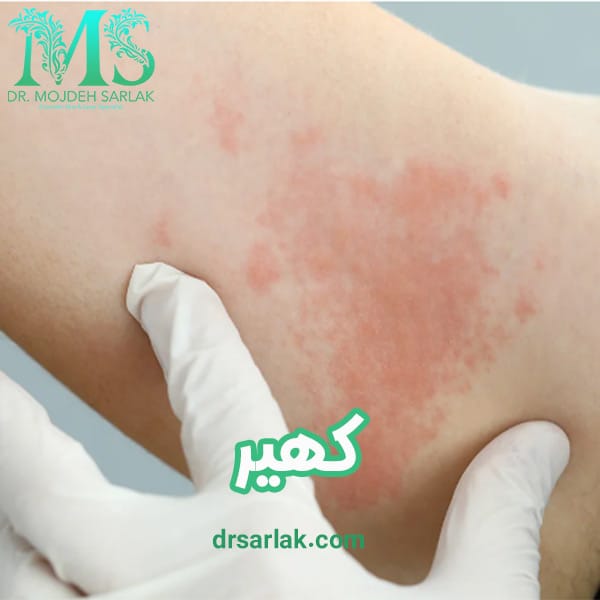 کهیر - دکتر مژده سرلک - drsarlak.com