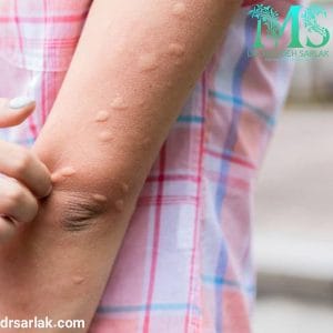 عفونت قارچی - دکتر سرلک - drsarlak.com