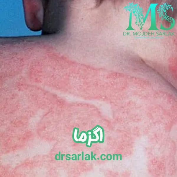 اگزما- دکتر مژده سرلک - drsarlak.com