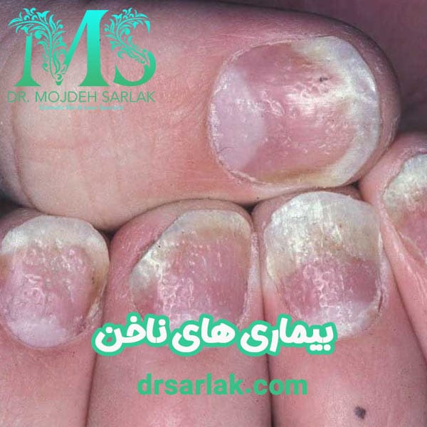 بیماری های ناخن - دکتر سرلک - drsarlak.com