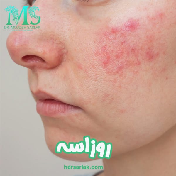 روزاسه - دکتر مژده سرلک - drsarlak.com
