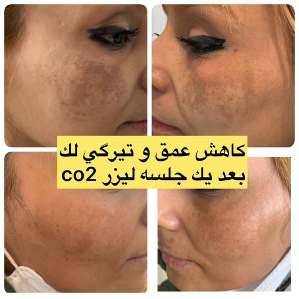 لیزر کک و مک صورت 