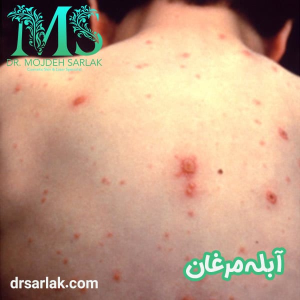 آبله مرغان - دکتر مژده سرلک - drsarlak.com