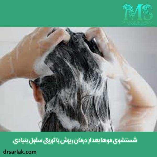 شستشوی موها بعد از تزریق سلول های بنیادی - دکتر مژده سرلک - drsarlak.com