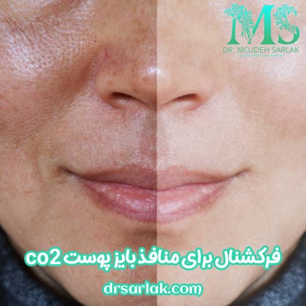 لیزر co2 فرکشنال برای منافذ باز پوست