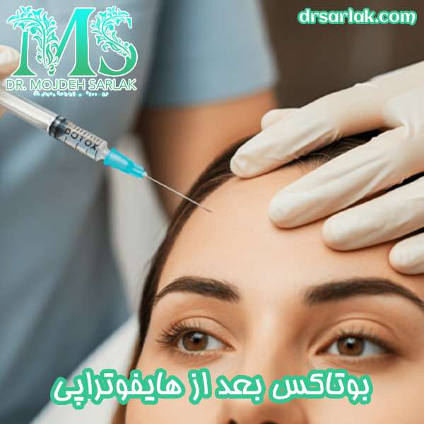 بوتاکس بعد از هایفوتراپی